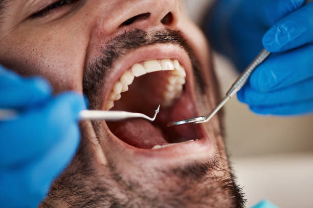 Best Emergency Dentist for Lost Fillings or Crowns in Pollock Pines, CA